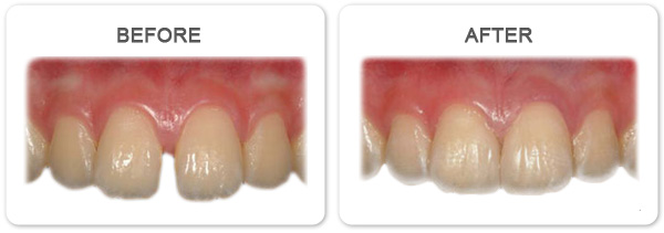 Aesthetic dentistry