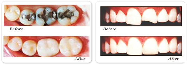 Fillings with highly resiliant, state-of-the-art tooth-colored materials
